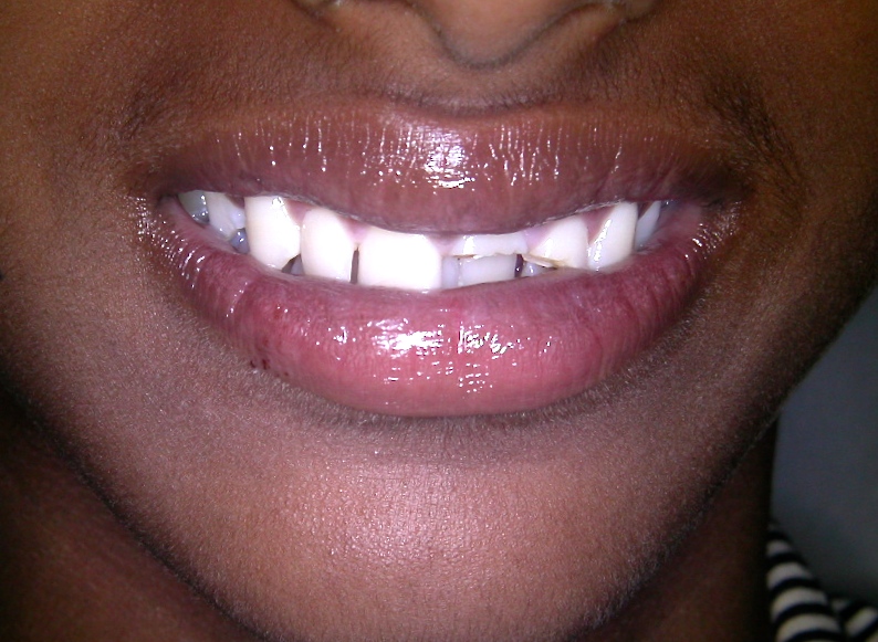 Fractured Tooth